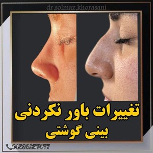 rhinoplasty-19
