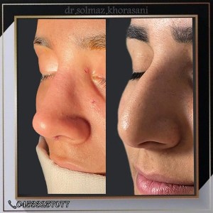 rhinoplasty-20