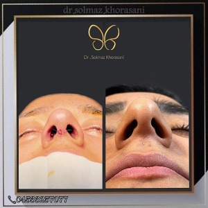 rhinoplasty-21