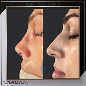 rhinoplasty-22