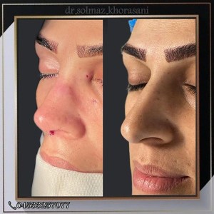 rhinoplasty-23