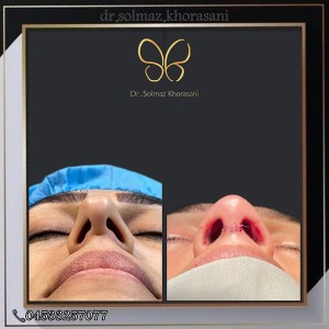 rhinoplasty-24