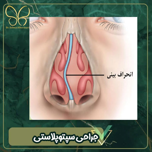 جراحی سپتوپلاستی - عمل صاف کردن تیغه بینی