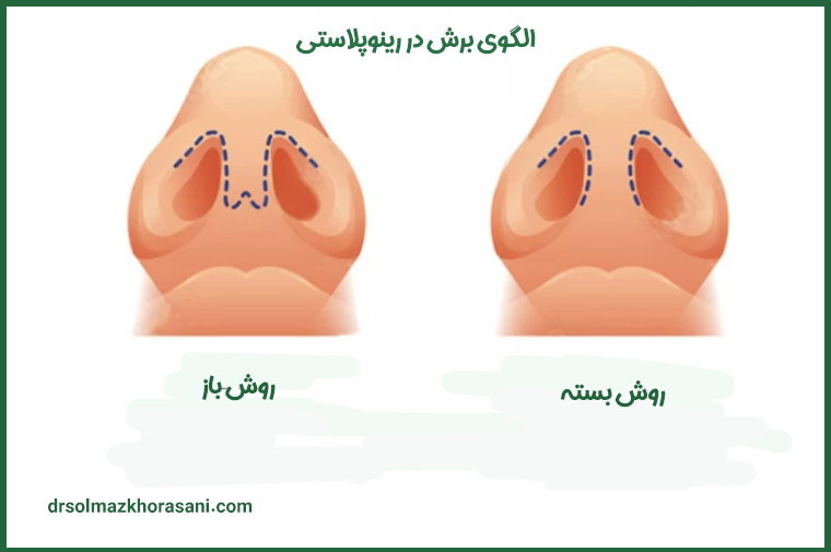 جراحی بینی به روش باز و بسته دکتر خراسانی مقدم -drsolmazkhorasani.com