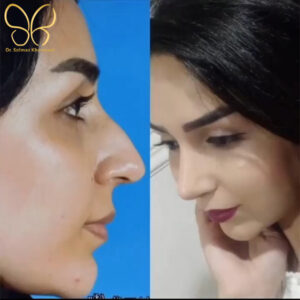 نتیجه جراحی بینی در اردبیل - دکتر خراسانی -drsolmazkhorasani.com