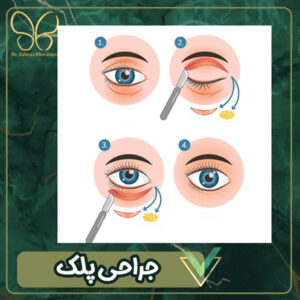جراحی پلک در اردبیل - بهترین جراح پلک اردبیل 