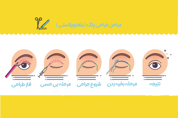 جراحی پلک - دکتر سولماز خراسانی مقدم 
