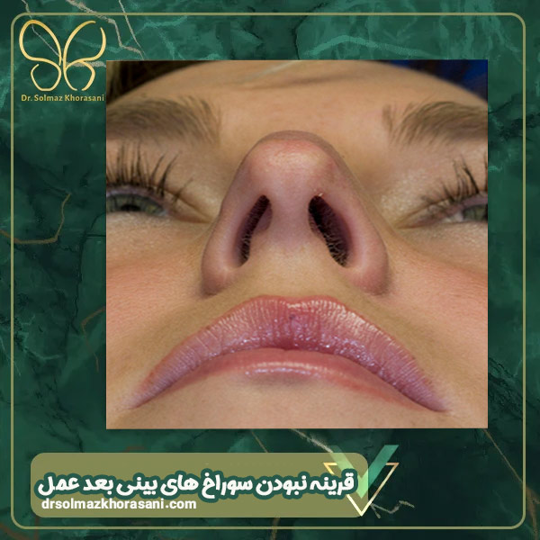 قرینه نبودن سوراخ های بینی بعد از عمل - دکتر سولماز خراسانی مقدم