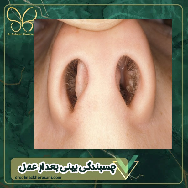 چسبندگی بینی بعد از عمل - دکتر سولماز خراسانی مقدم