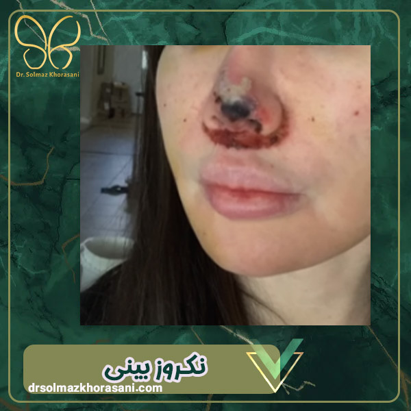 نکروز بینی - دکتر سولماز خراسانی مقدم