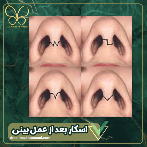 اسکار بعد از عمل بینی - دکتر سولماز خراسانی مقدم
