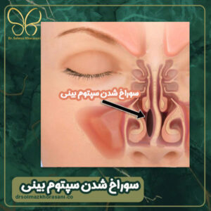 سوراخ شدن سپتوم بینی - دکتر سولماز خراسانی مقدم