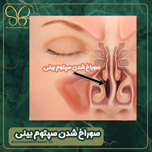 سوراخ شدن سپتوم بینی - دکتر سولماز خراسانی مقدم