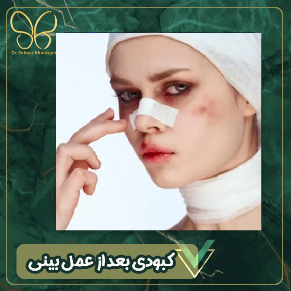 کبودی بعد از عمل بینی - دکتر سولماز خراسانی مقدم